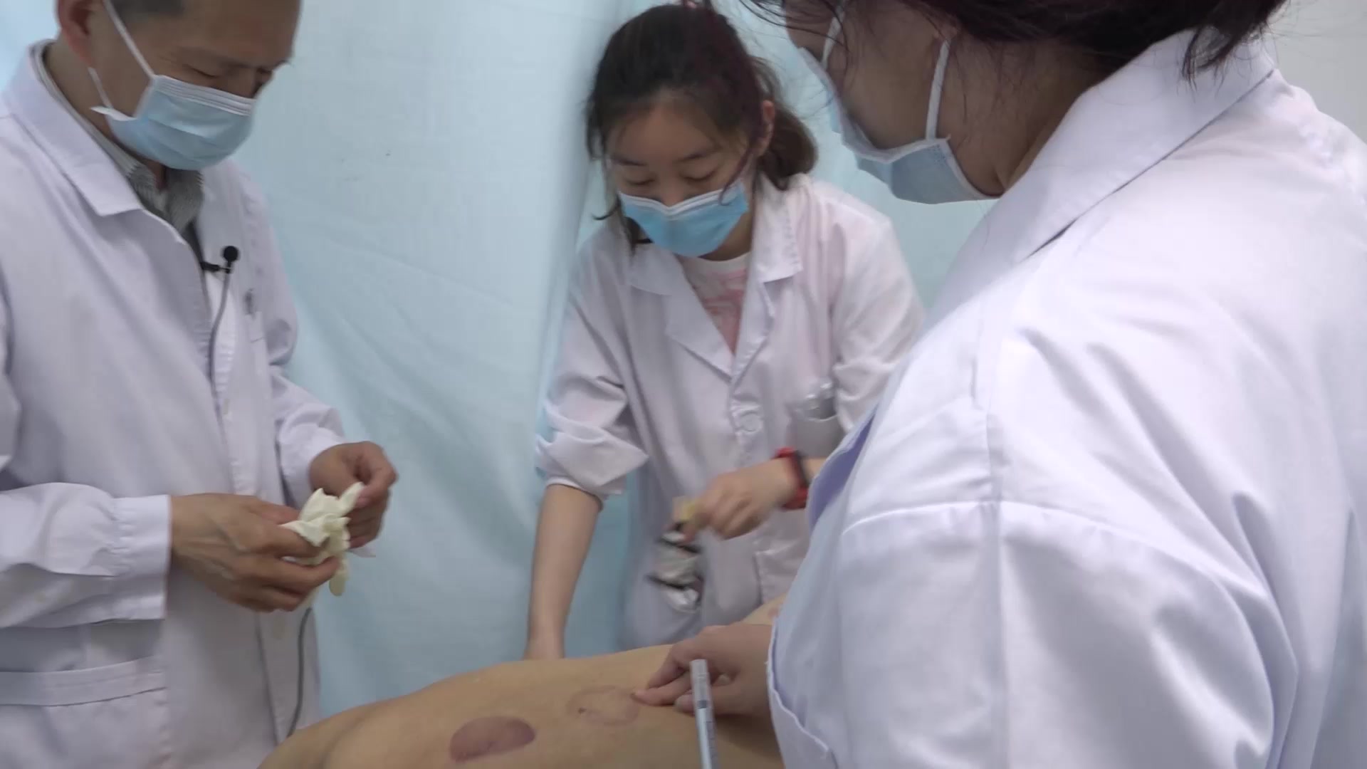 寒湿瘀阻经络：65岁男性腰痛十余年大腿木的走罐针刀外治法