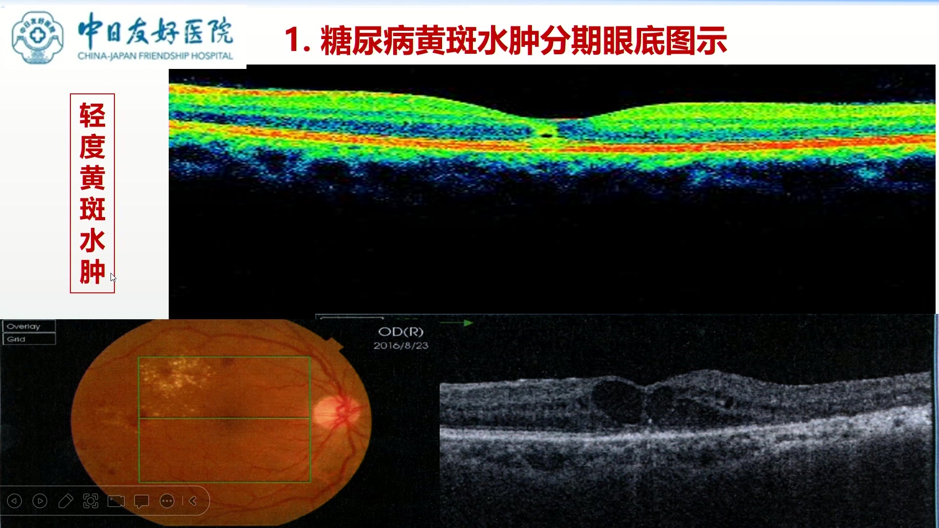 糖尿病视网膜病变及黄斑水肿早期预警与中药防治(2)