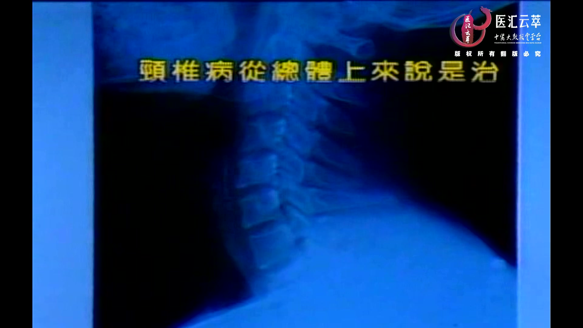 颈椎病Ⅱ环齿关节错位针刀治疗