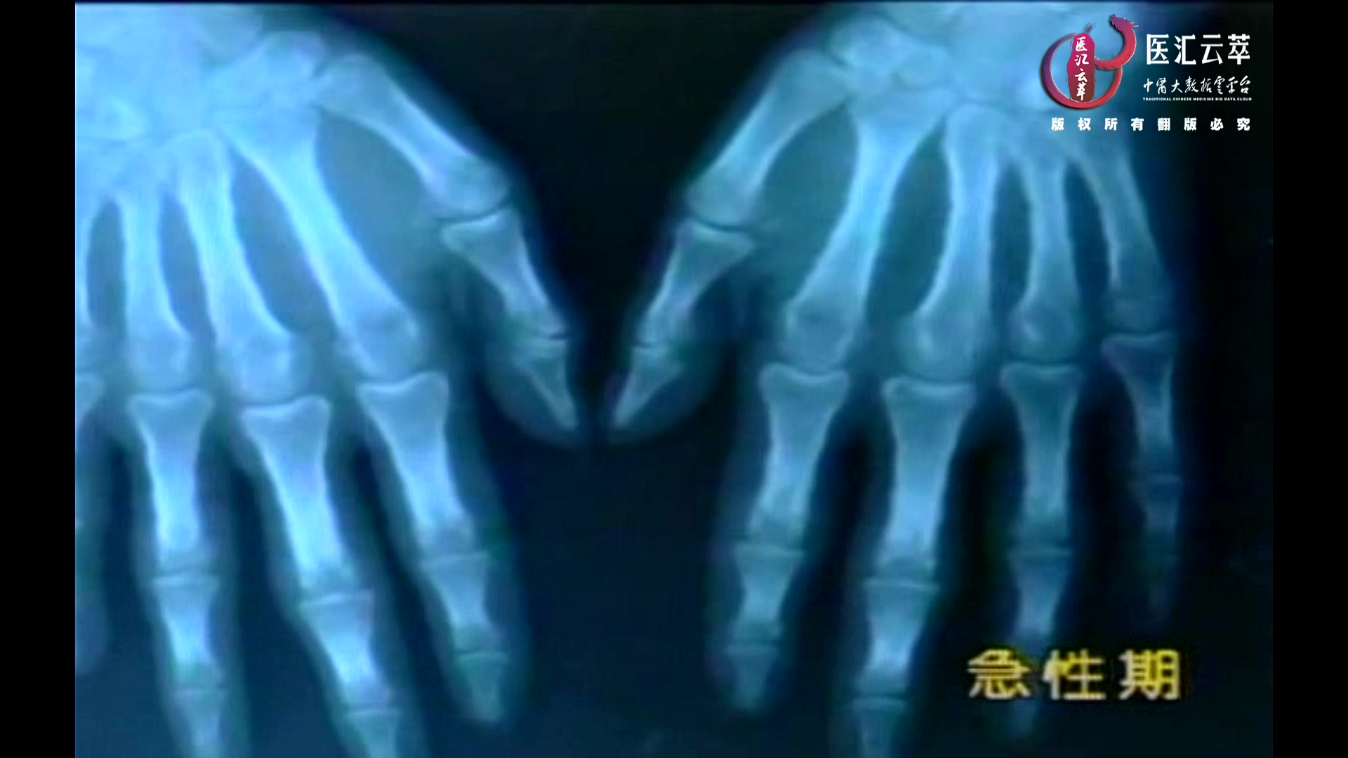 类风湿性关节炎Ⅰ急性期Ⅱ肘关节强直针刀治疗